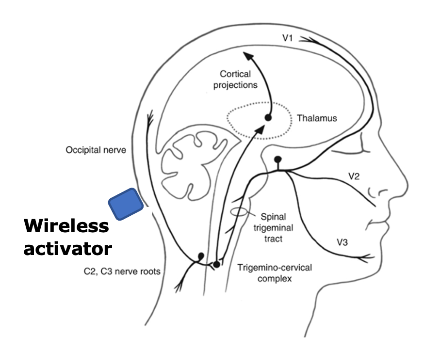 A graphic depicting a person’s head and brain with Jitendran Muthuswamy’s neurostimulation device that can relieve chronic migraine headaches through electrical stimulation.