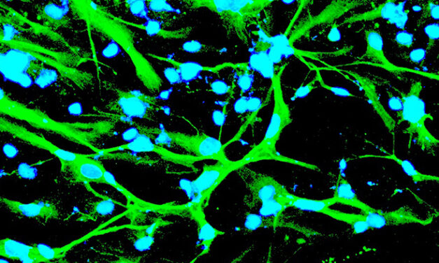 Stem cells help untangle Alzheimer’s, other disease origins