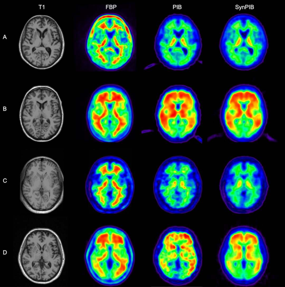 Using AI to battle Alzheimer’s